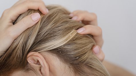 Seboroická dermatitida: Jak ji poznat a dostat pod kontrolu?