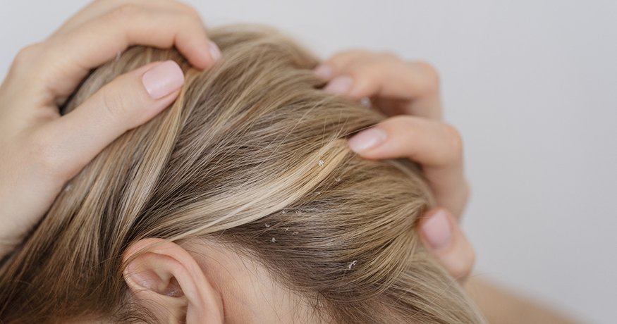 Seboroická dermatitida: Jak ji poznat a dostat pod kontrolu? - hero