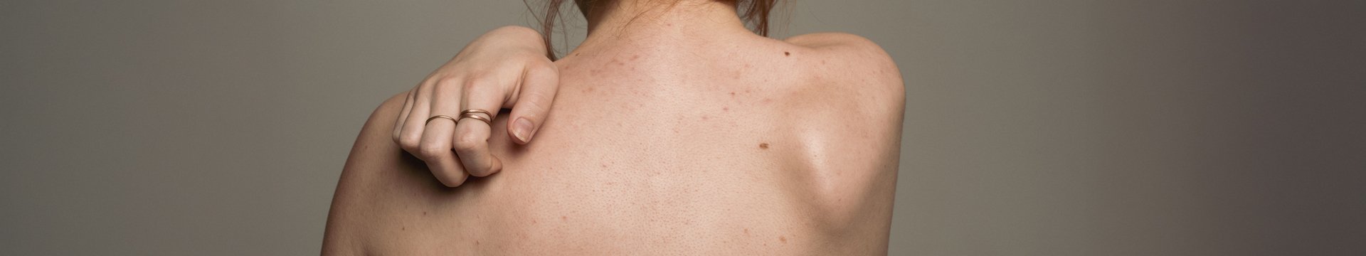 Jak si poradit s hnědými skvrnami na kůži? - header