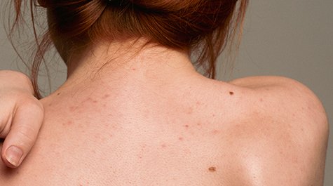 Jak si poradit s hnědými skvrnami na kůži?