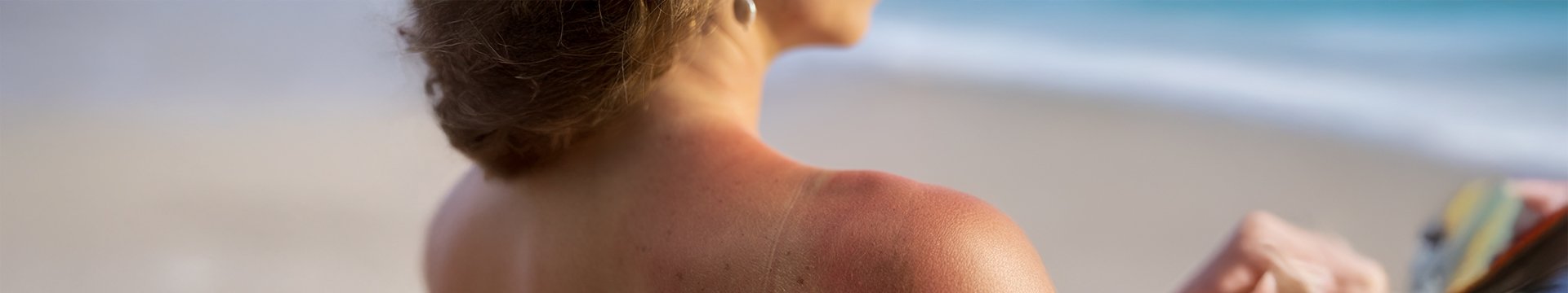 Jak se zbavit sluneční vyrážky a skvrn? - header