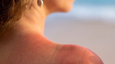 Jak se zbavit sluneční vyrážky a skvrn?