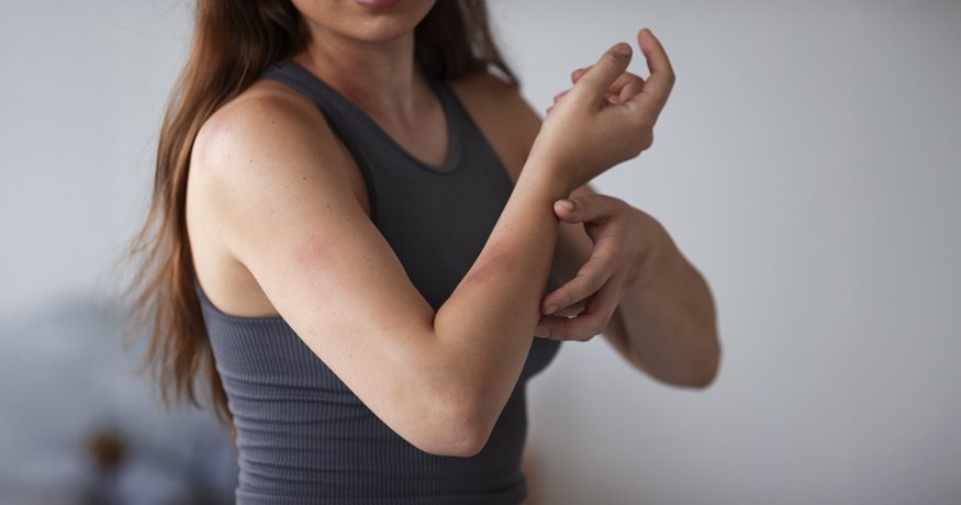 Co pomáhá na atopický ekzém? Průvodce péčí o citlivou pokožku - Hero