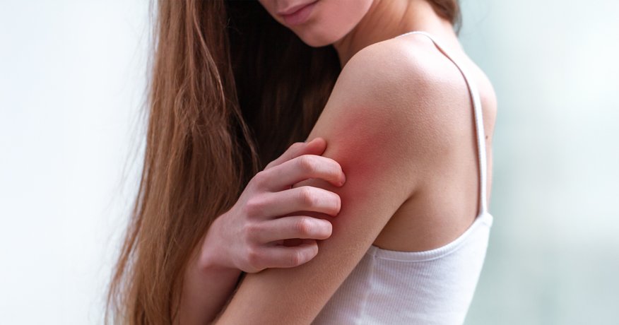 Jaké jsou nejčastější druhy ekzému a jak je rozpoznat? Hero