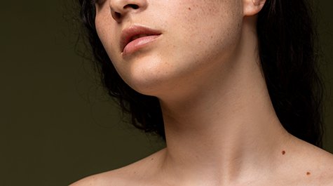 Hnědé skvrny na kůži a jak se jich zbavit