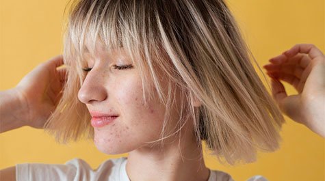 Pleť a akné v pubertě – Jak se ho zbavit?