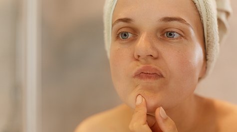 Problematická pleť: Jak o ni pečovat?