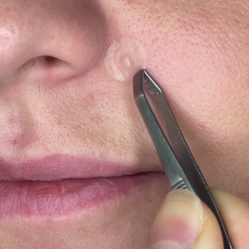 Pimple Patches Video Thumbnail